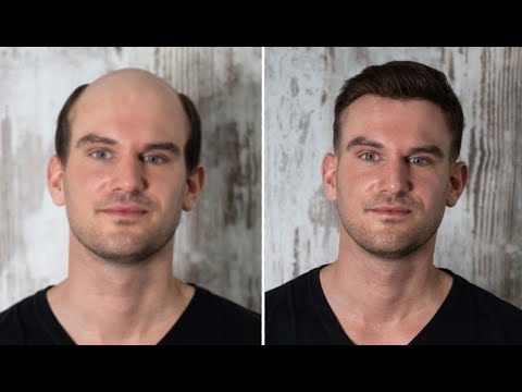 Hair System Transformation Mane Systems Australia